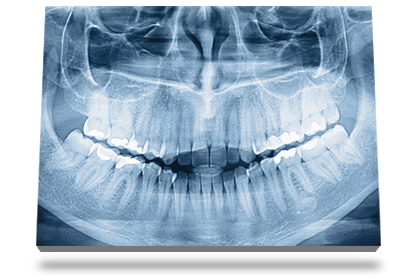 Radiographie dentaire