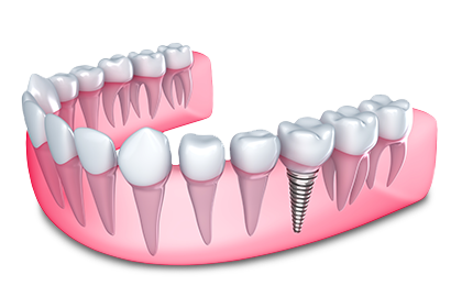 prothèse dentaire stable et fiable